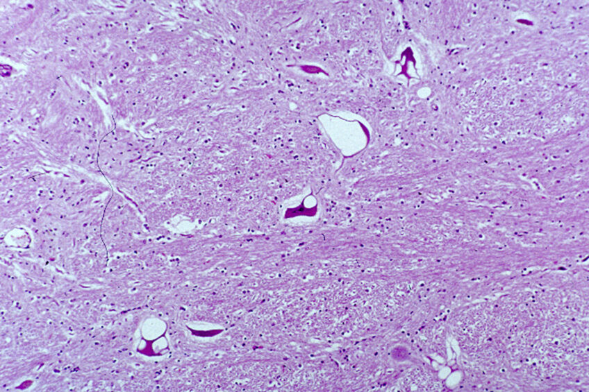 5 BSE cases confirmed in Europe